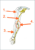 Schematische Abbildung: 1. Humerus, 2. Nervus ulnaris, 3. Radius, 4. Sulcus nervi ulnaris