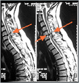 Kernspintomographie (MRT): Cervikale Myelopathie, links: Medialer Vorfall, rechts: Myelopathie