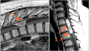 Beeld links: MRI van een meningeom in de thoracale wervelcanal Beeld rechts: Tumor in het ruggemerg