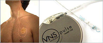 Vagus Nerv Stimulation mit einer Platindrahtelektrode