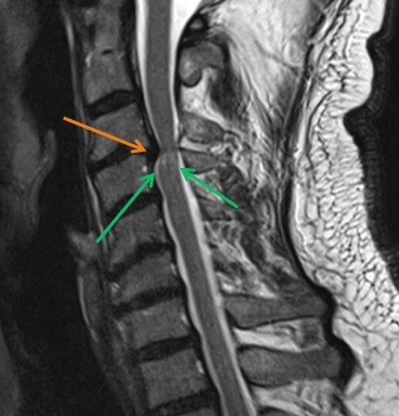 Cervical spine – Cervical myelopathy1