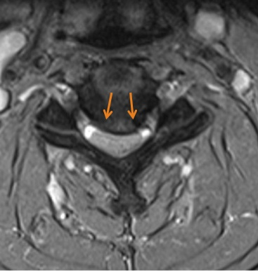 Cervical spine – Cervical myelopathy2