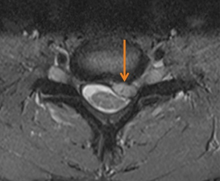 Cervical spine – Disc herniation