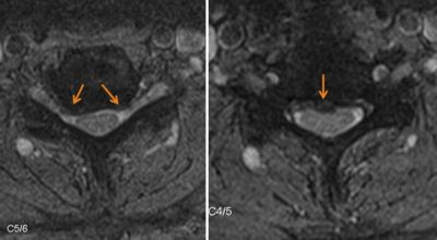 Cervical spine – Stenosis2