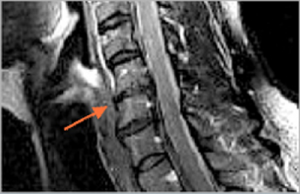 Cervical spine Stenosis3 PD Dr. med Andreas Frank
