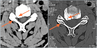 Cervical spine – foraminal stenosis