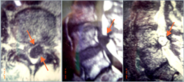 Expansive lesion2