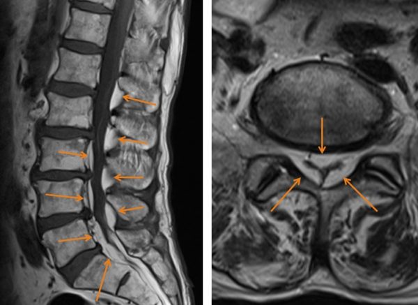 Raumforderungen im Wirbelkanal PD Dr. med Andreas Frank