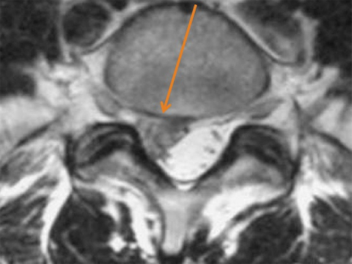 Lumbar spine1