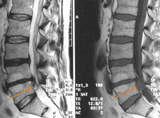 Lumbar spine2