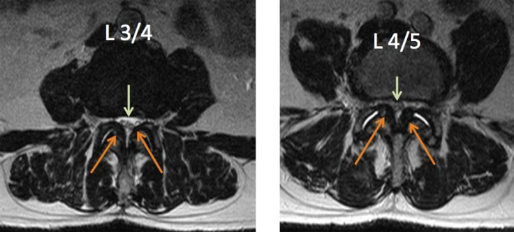 Lumbar spine3