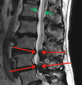 Lumbar spine4